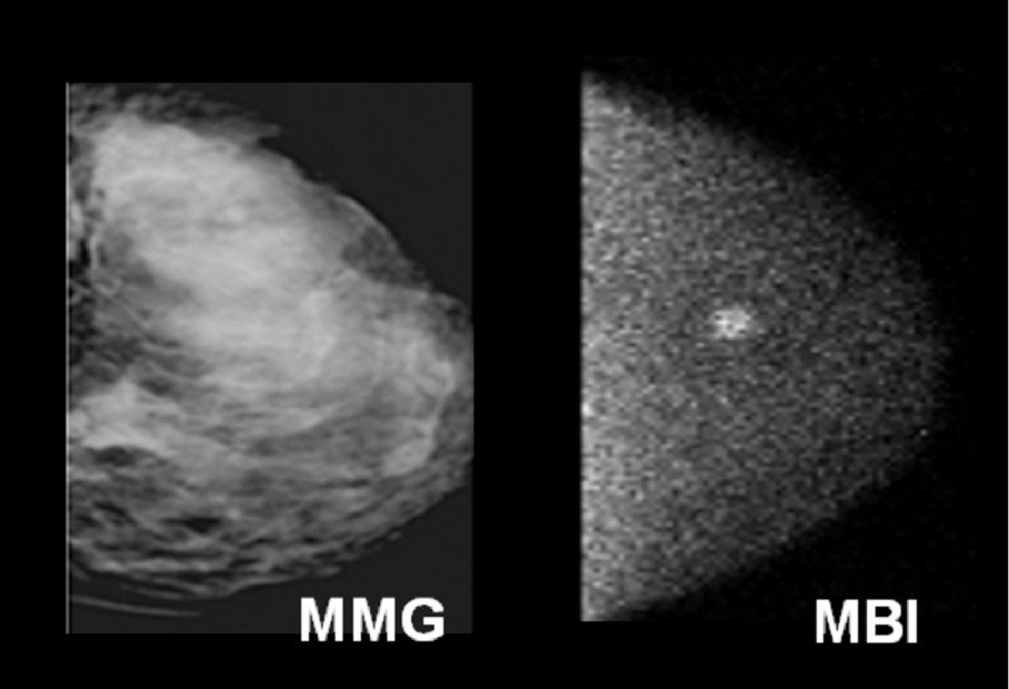 Molecular Breast Imaging vs. Mammography