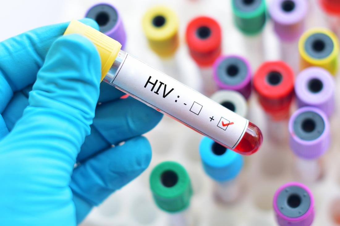 بیمار مبتلا به HIV ، بدون درمان بهبود پیدا کرد
