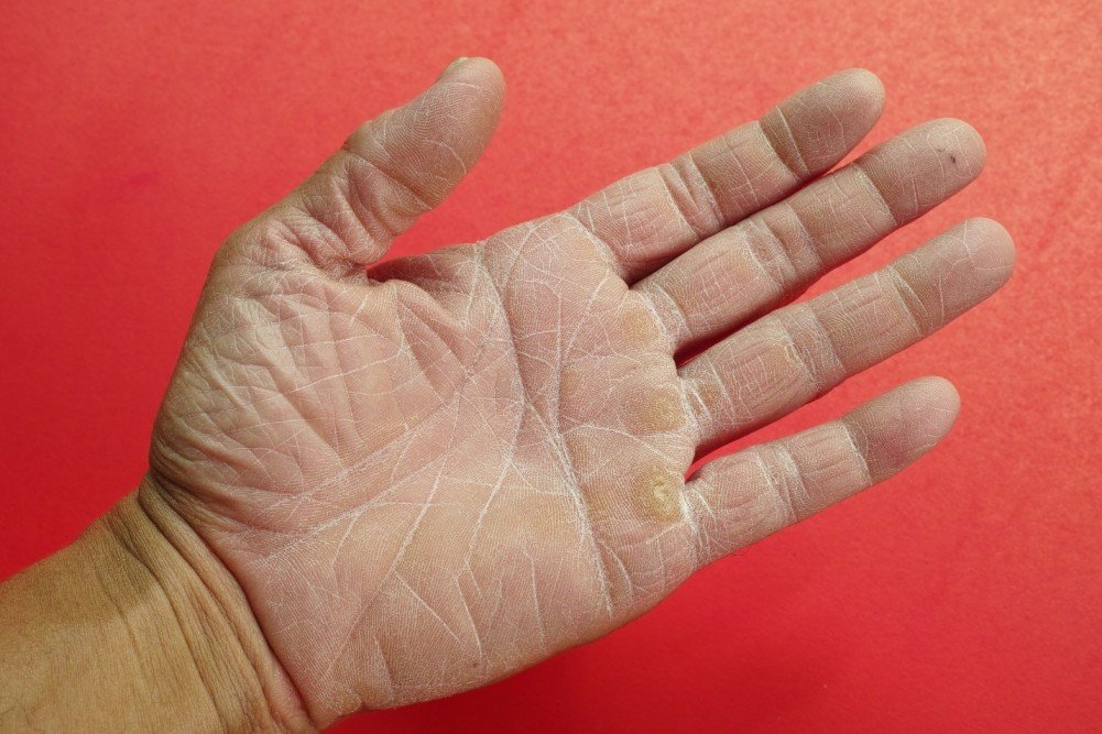 dry hand skin
